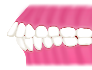 上顎前突(出っ歯、反っ歯)