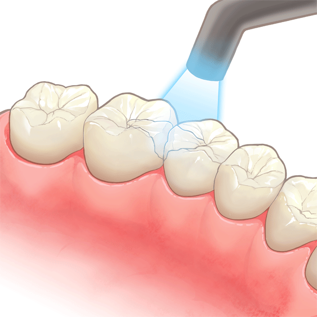 コンポジットレジンを詰め光で固める