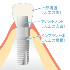 インプラントは第二の天然歯とまで言われています