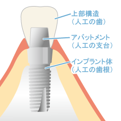 第二の天然歯